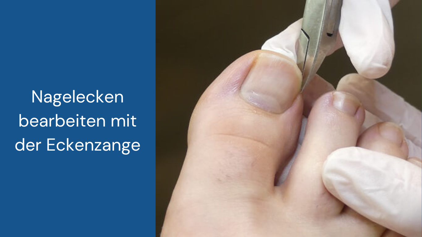 Zehennägel schneiden mit einer Eckenzange