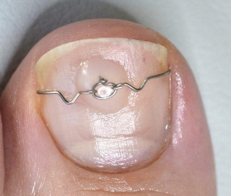 Eingewachsenen Zehennagel behandeln mit einer Nagelspange