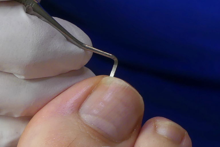 Rollnägel schneiden - Sondieren des Nagels mit dem Excavator