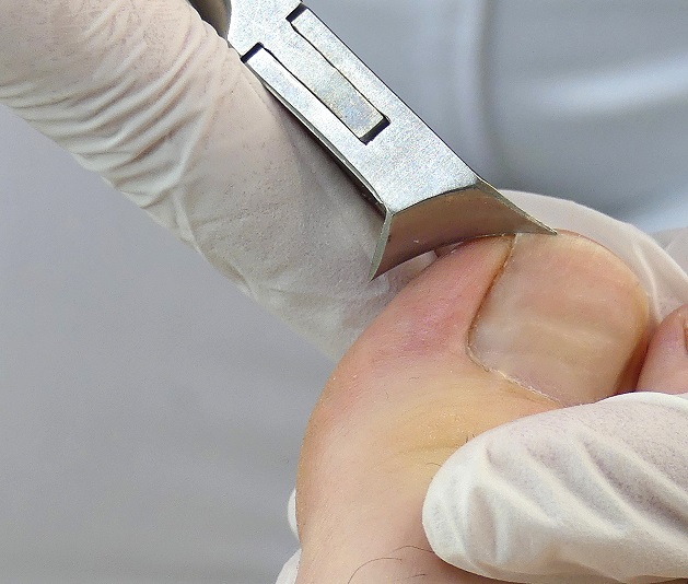 Ein richtiger Nagelschnitt am Großzehennagel hilft um eingewachsene Zehennägel vorzubeugen