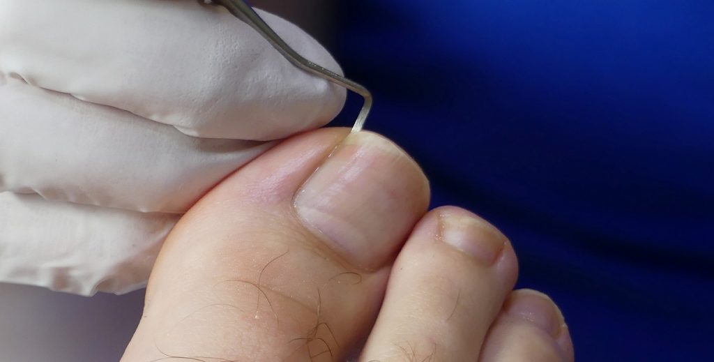 Eingewachsenen Zehennagel schneiden - Das Sondieren des Nagelfalzes nach dem Schneiden der Nägel