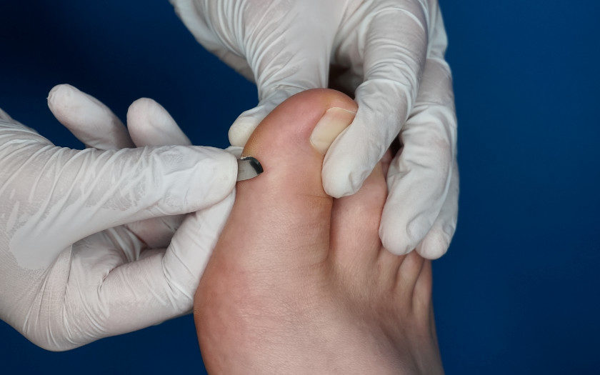 Skalpelltechnik Fußpflege