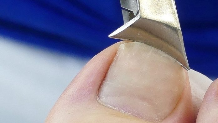 Eingewachsene Zehennägel schneiden mit einer Nagelzange