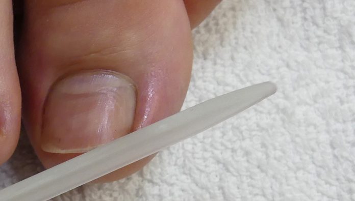 eingewachsenen-nagel-schneiden Zehehnägel richtig feilen mit einer Glasfeile um eingewachsenen Zehennägeln vorzubeugen