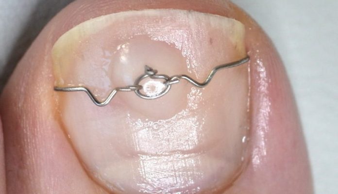 eingewachsenen zehennagel behandeln mit Nagelkorrekturspange Eingewachsenen Zehennagel behandeln mit einer Nagelspange