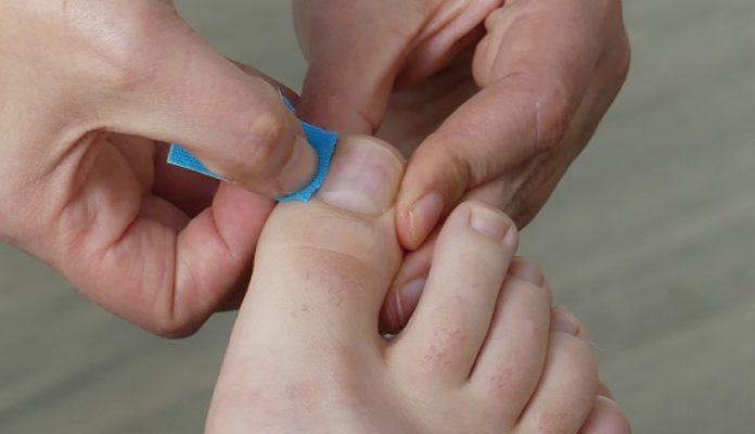 nagel-tapen Den Nagelfalz tapen bei einem eingewachsenen Nagel