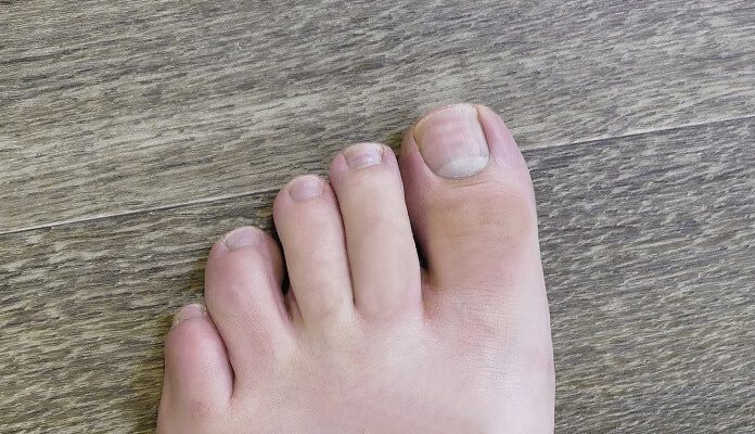 Zehennagel Die Richtige Nagelform Und Lange Fusspflegeblog