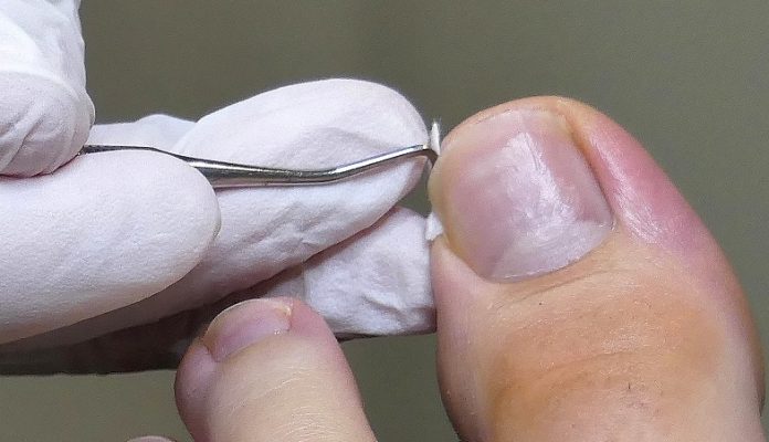 rollnägel-behandeln Nagelfalztamponade - Eine Behandlungsmethode von Rollnägeln