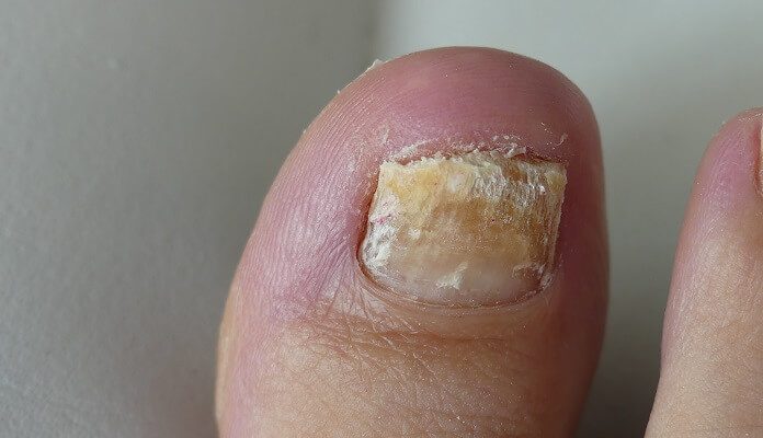 wie-erkenne-ich-nagelpilz wie-erkenne-ich-nagelpilz